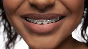How Much Do Braces Cost in South Africa?
