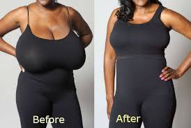 Mastopexy Surgery: Everything South African Women Need to Know About Breast Lift Procedures
